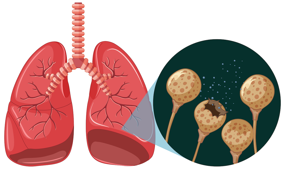 COPD