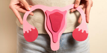 PCOS - Thuispoli PCOS