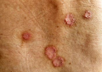Ringworm (tinea corporis): symptomen & behandelopties