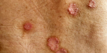 Ringworm (tinea corporis): symptomen & behandelopties