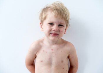 Waterpokken: oorzaken, symptomen & behandelopties