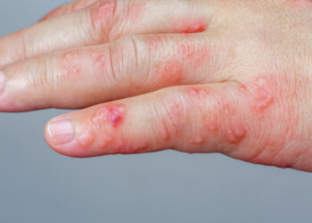 Gordelroos: oorzaken, symptomen & behandelopties