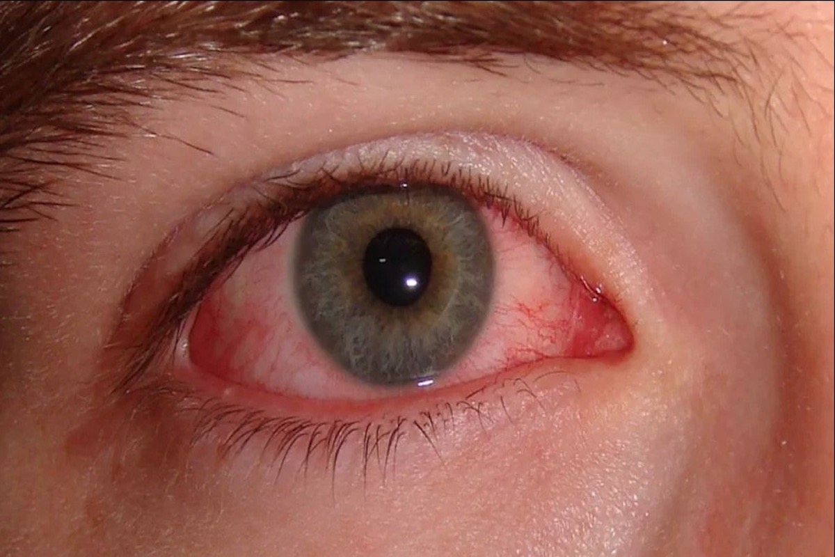 oogontsteking (conjunctivitis)